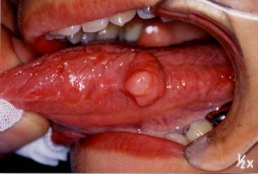 舌の良性腫瘍