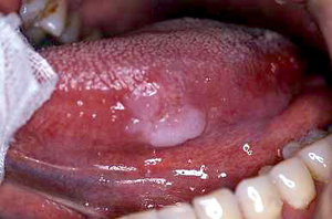 舌の悪性腫瘍