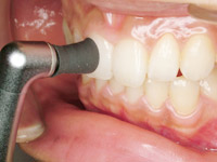 歯のクリーニング写真